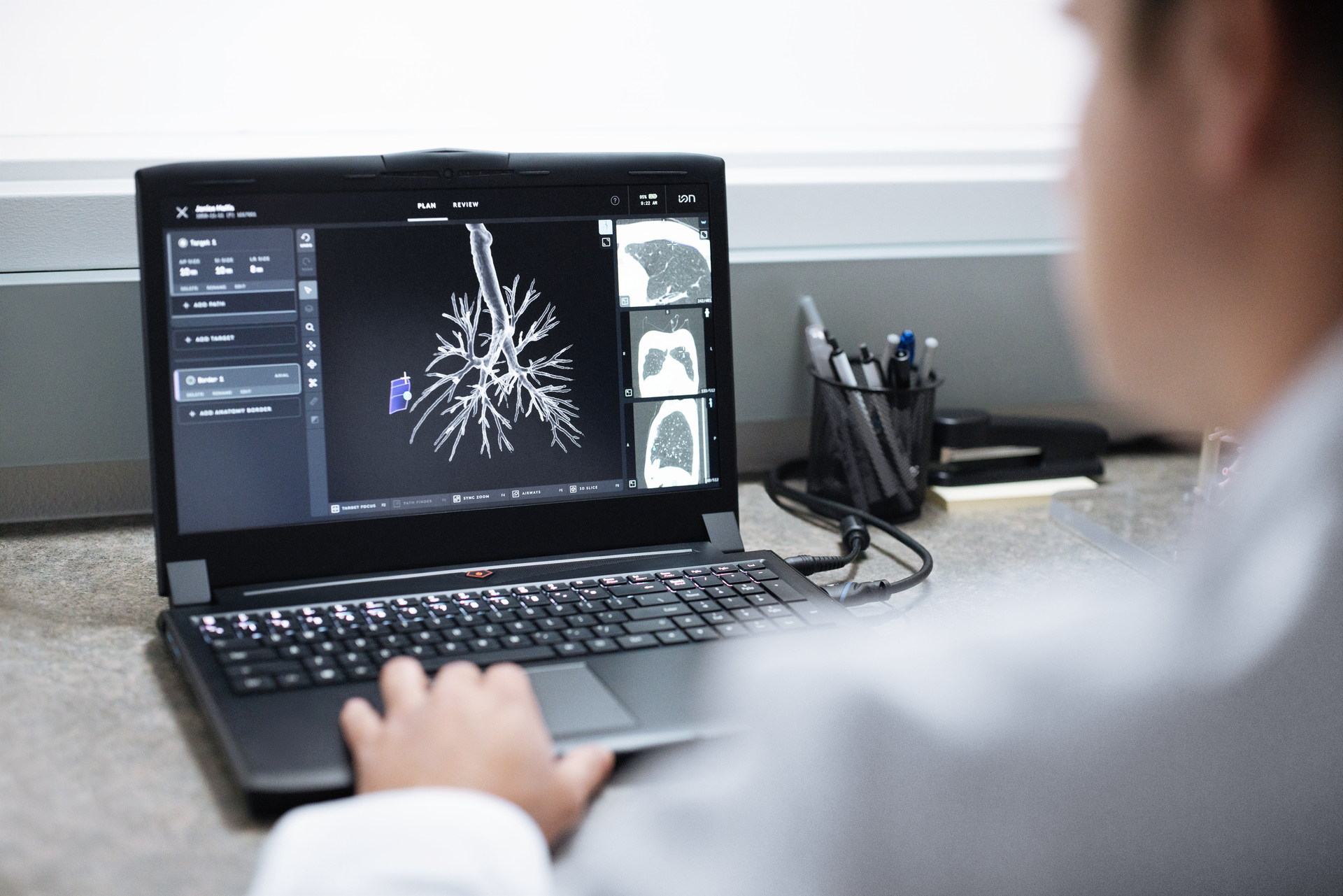 JPG Medium ION LS Patientplanning OS 082017 RGB