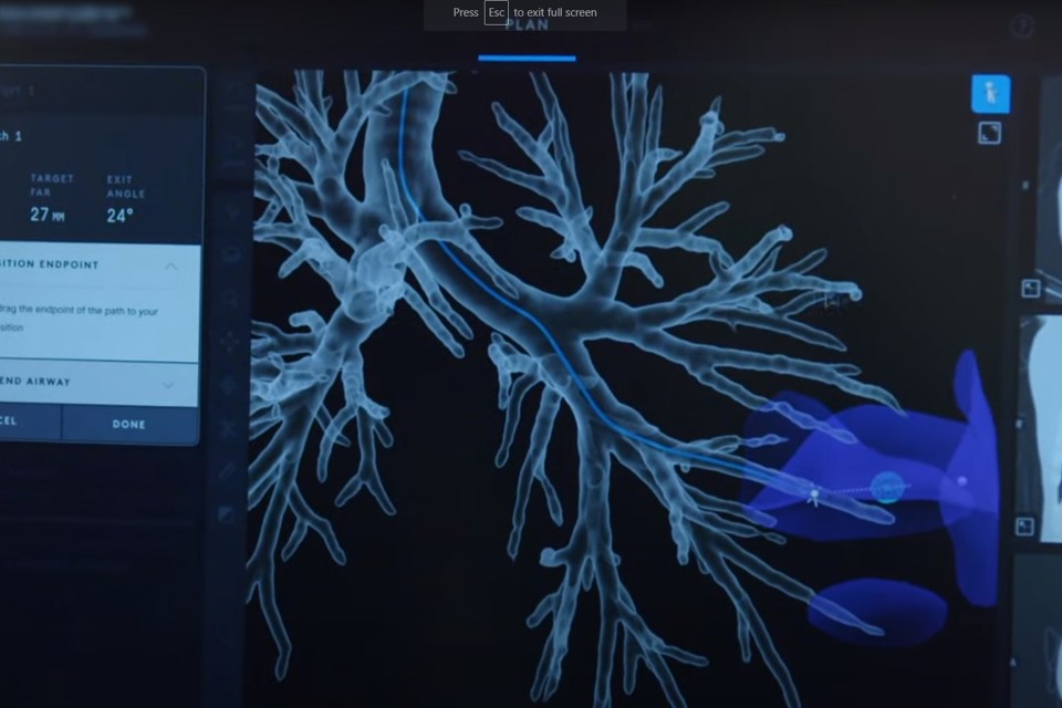 Race To Catch Lung Cancer